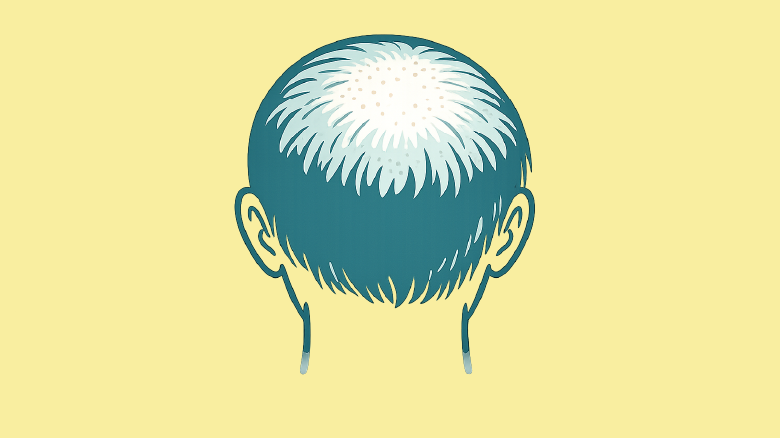 びまん性脱毛症のイラスト