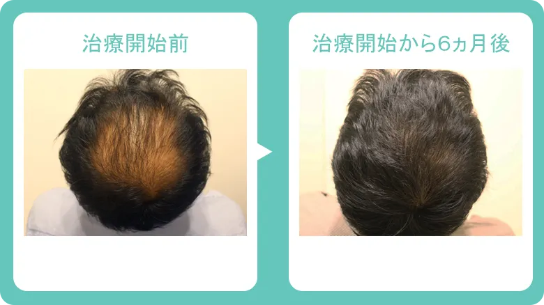 銀クリ症例写真1