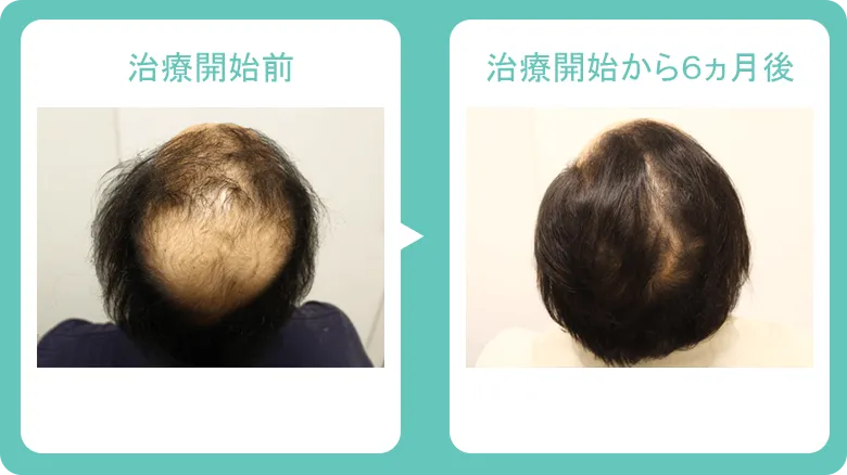 銀クリ症例写真2