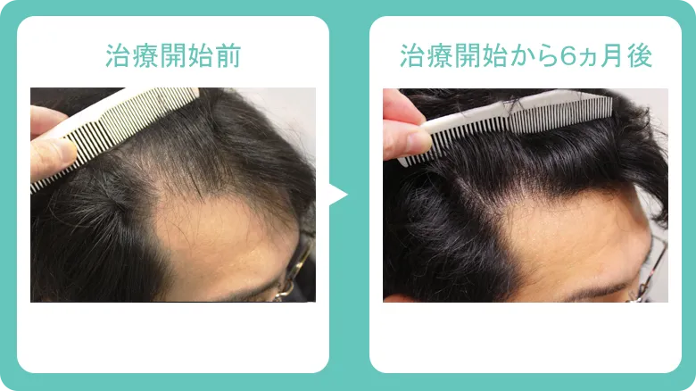 銀クリ症例写真3